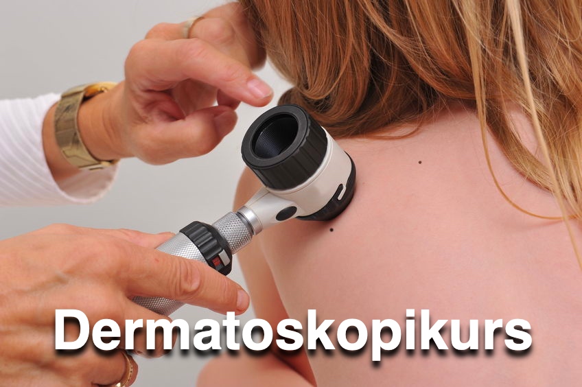 Dermatoskopikurs i Stockholm Dermatoskopikurs i Stockholm