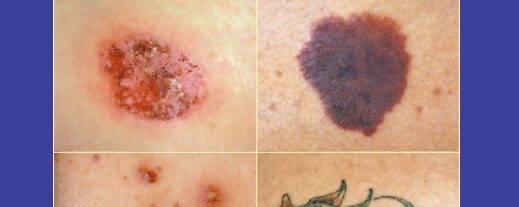 Hudatlas – översikt i dermatologi