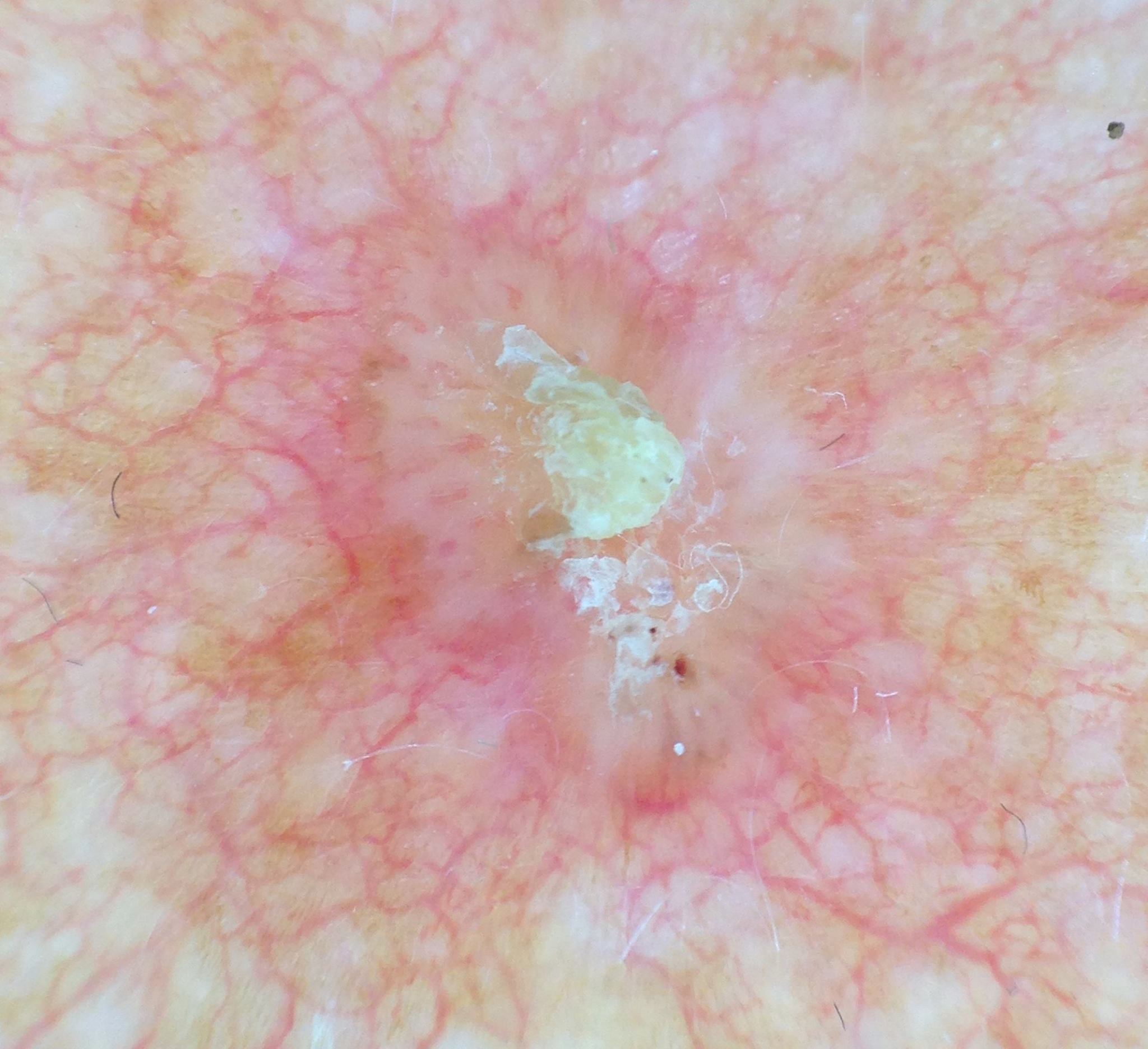 Skivepitelcancer Skivepitelcancer in situ. Foto: John Paoli.